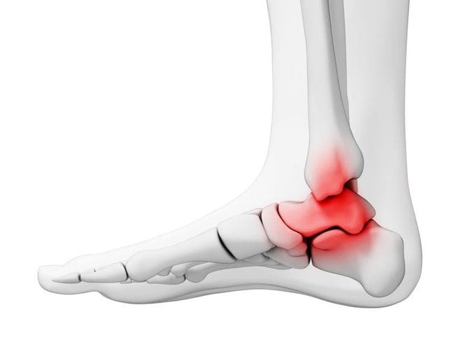 Blog picture of Ankle Arthritis
