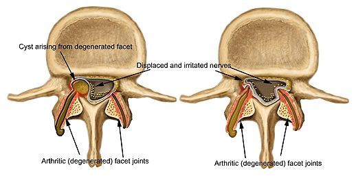 Blog Image  Facet Joint Arthritis
