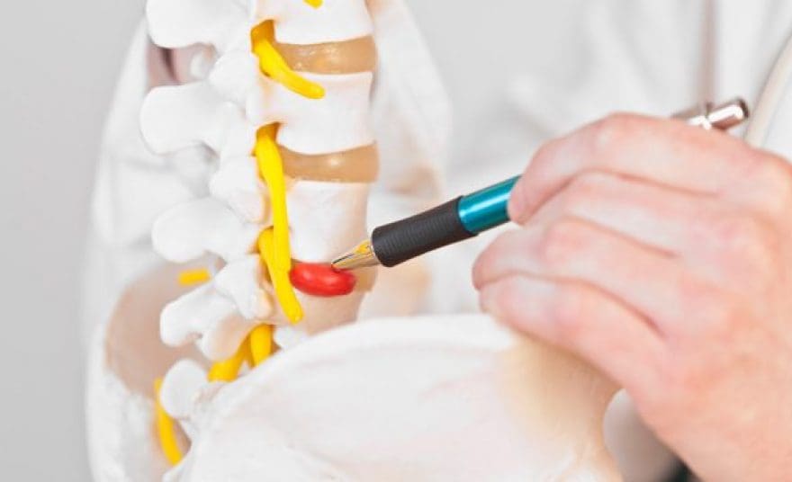 Scientific Chiropractor: Herniated Disc Signs and Symptoms