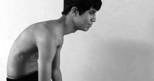 blog picture of hunched back teen