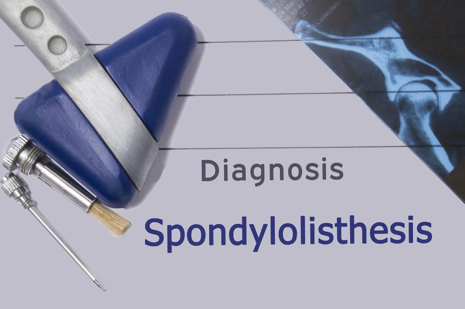 neurological diagnosis of spondylolisthesis neurologist