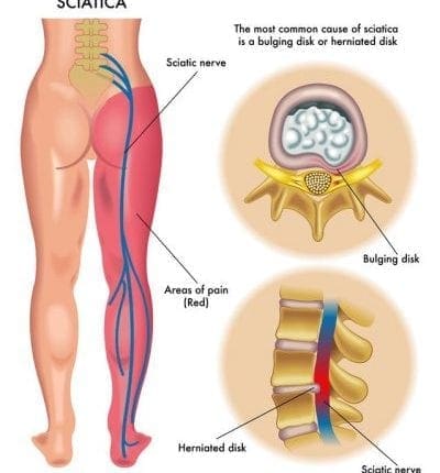 Managing Sciatic Nerve Health Through Functional Care