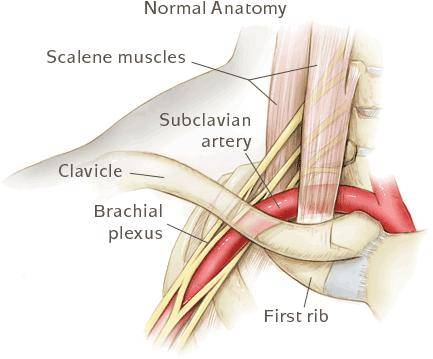 thoracic outlet syndrome diagram