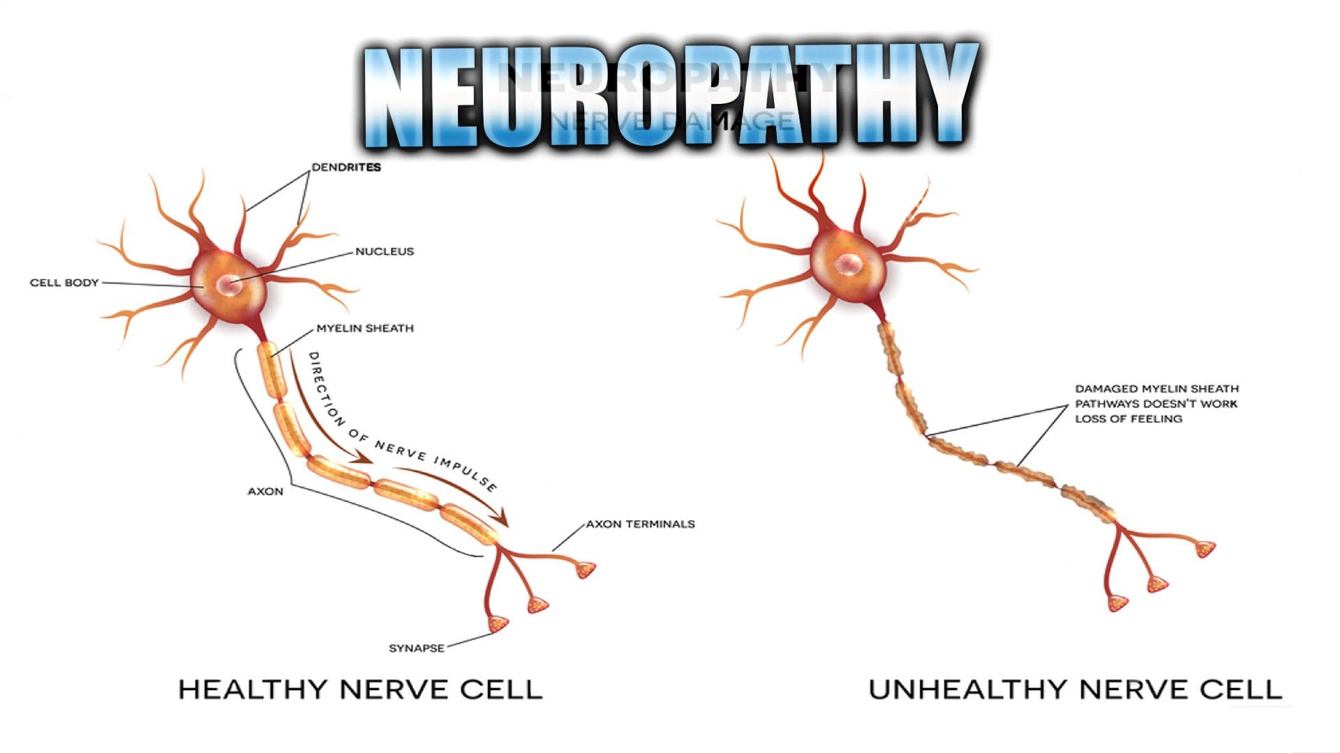neuropathy presentation el paso tx.