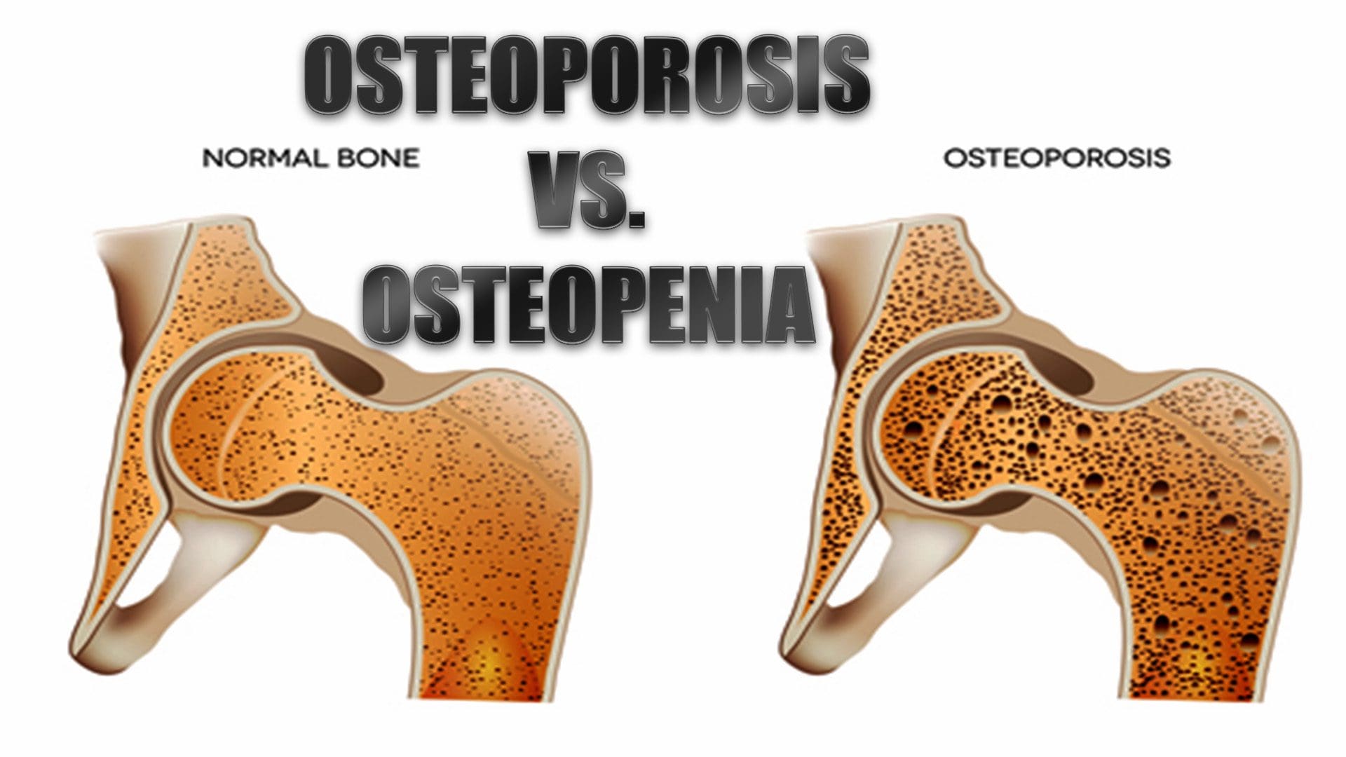 osteoporosis el paso tx.