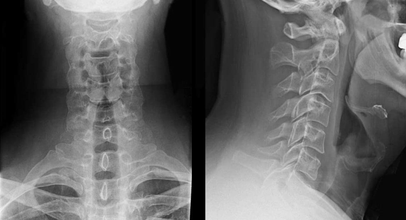 Cervical Spine Radiographs in the Trauma Patient