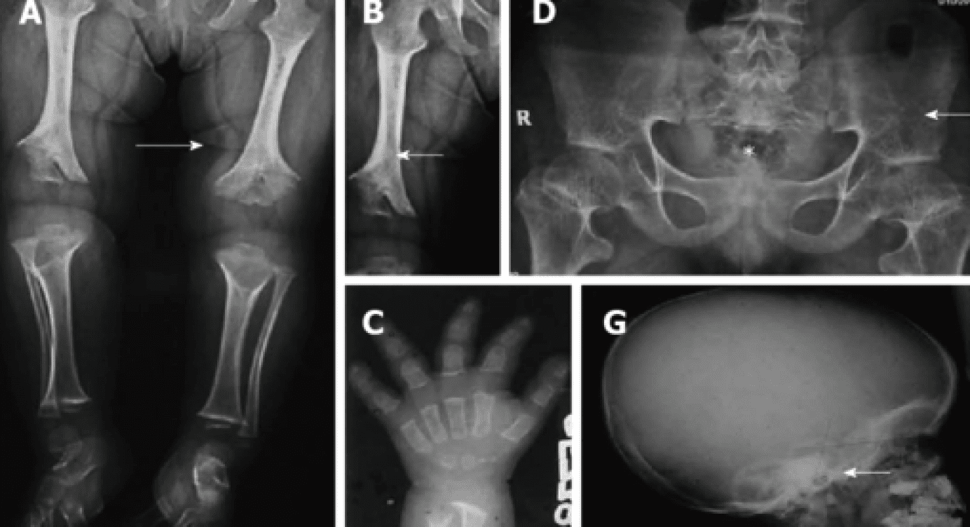 Achondroplasia Clinical Presentation