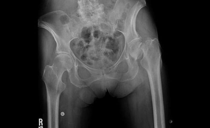 Impacted Femoral Neck Fractures | El Paso, TX Chiropractor