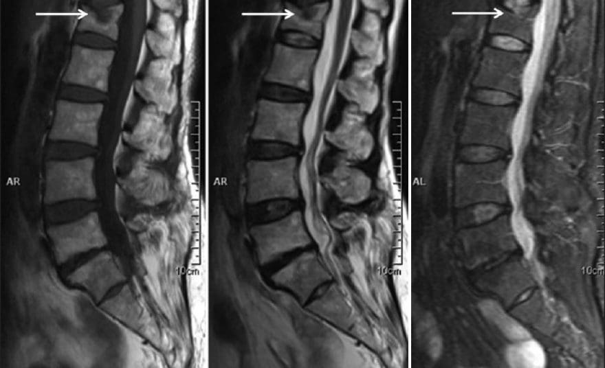 Vertebral Fracture Diagnosis Imaging Studies | El Paso, TX Chiropractor
