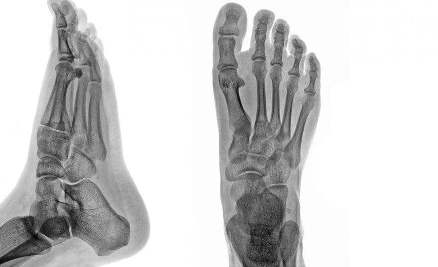 ankle foot arthritis and trauma el paso tx.