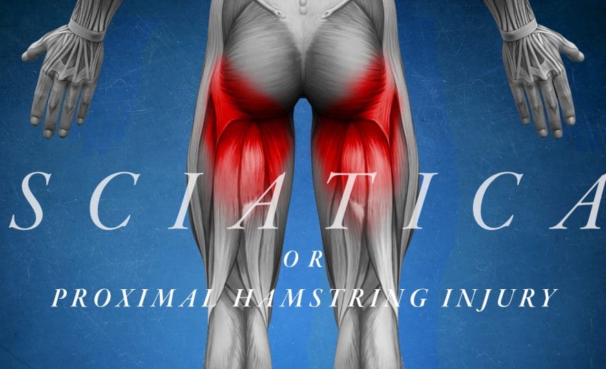 Sciatica or Proximal Hamstring Injury | El Paso, TX Chiropractor