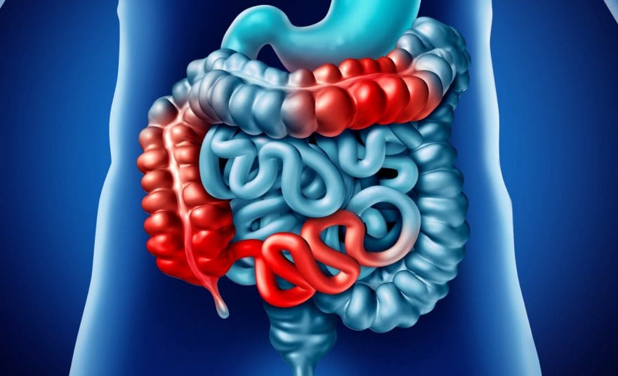 What is Crohn's Disease? An Overview | El Paso, TX Chiropractor