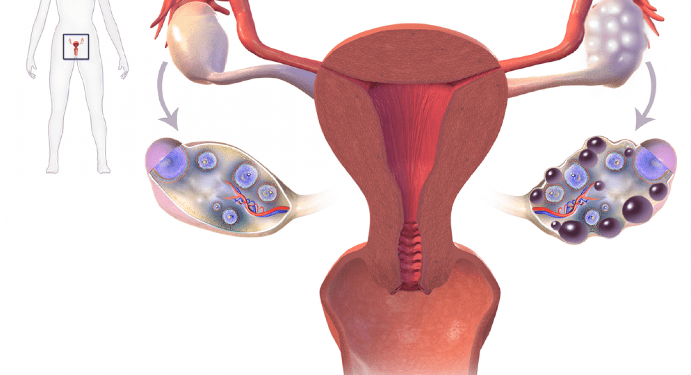 PCOS: A Genetic Predisposition-Part 1