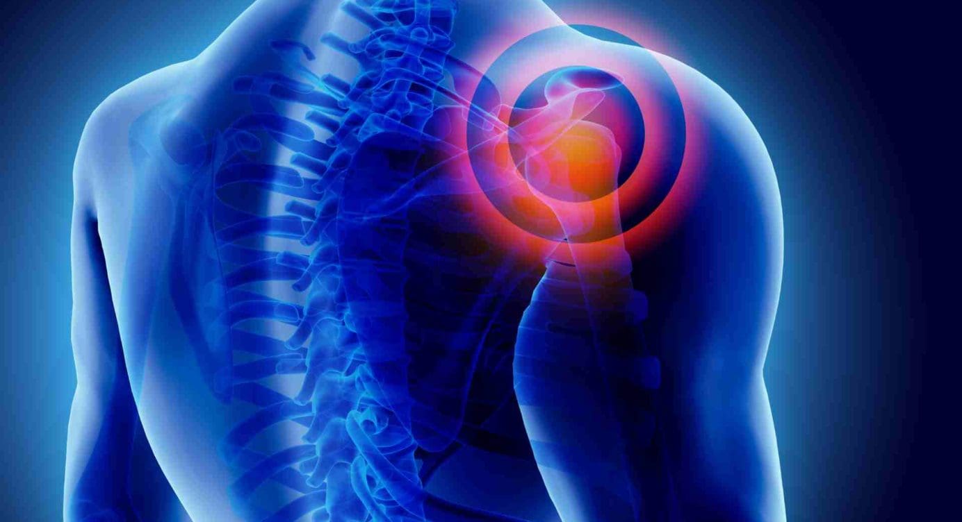 Shoulder Joint Pain Associated With Trigger Points