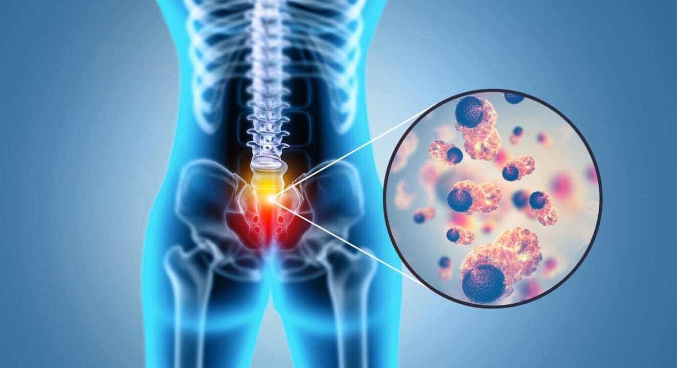 Common Pathology of Lumbar Disc Degeneration Issues