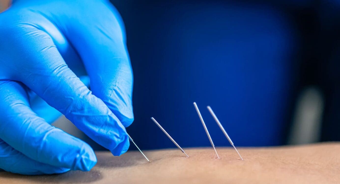 Acupuncture Therapy for Arthritis Relief: A Guide