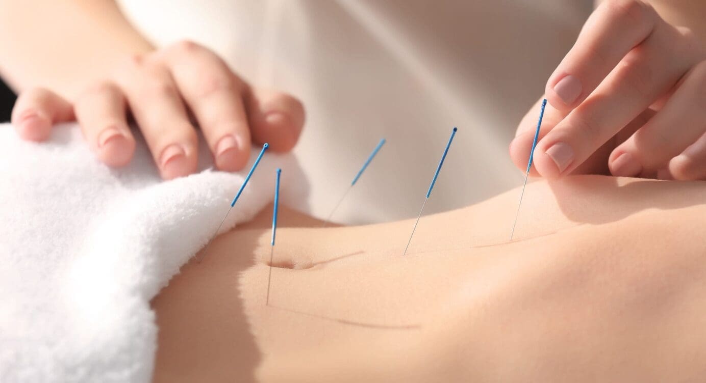 Acupuncture: A Natural Solution for Reducing Gut Inflammation