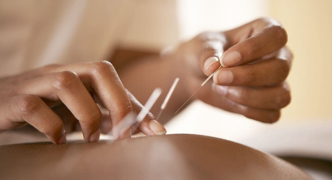 Discover The distinction Between Dry-Needling and Acupuncture