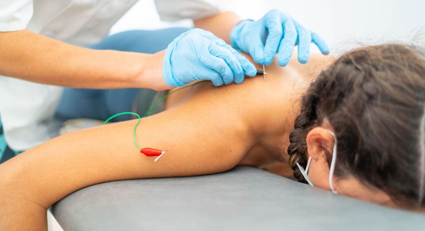 Using Acupuncture to Improve Athletic Performance