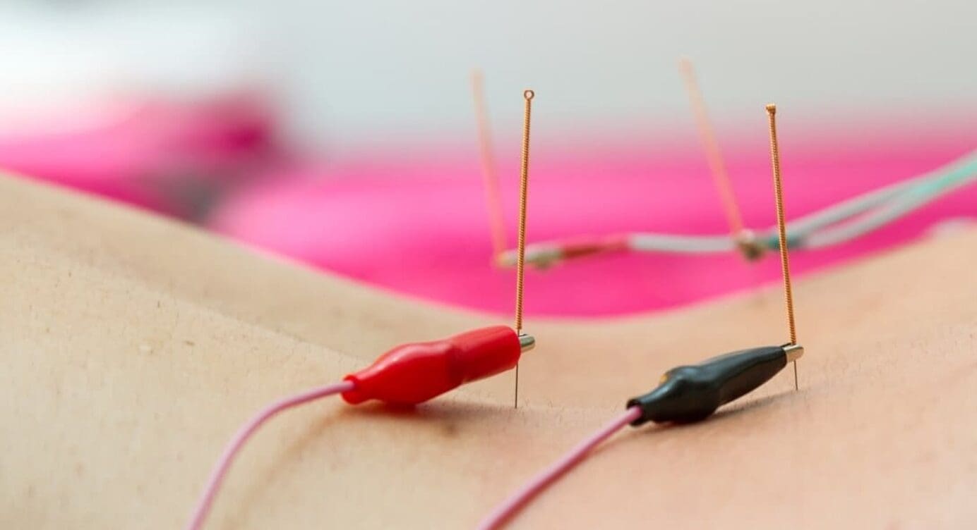 Electroacupuncture for Musculoskeletal System Care