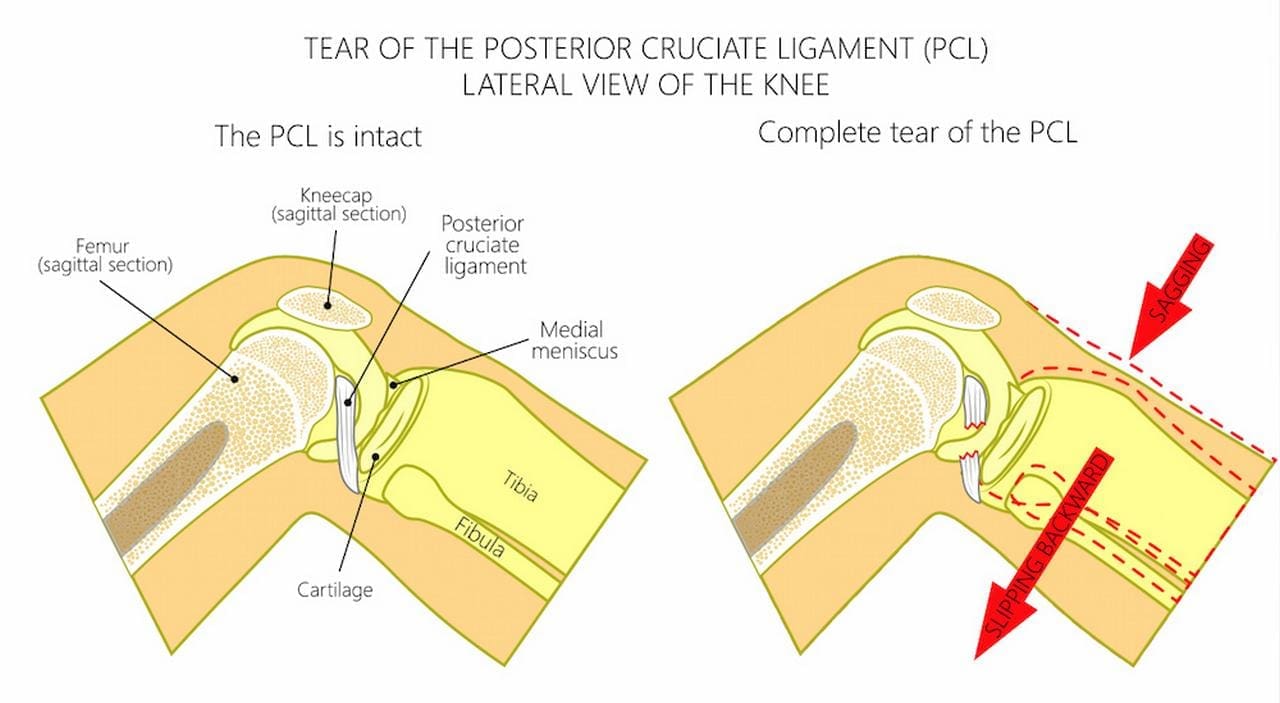 Car Accident Dashboard Knee Treatment and Rehabilitation